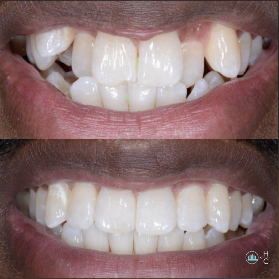 Stay Aligned clear retainer smile result